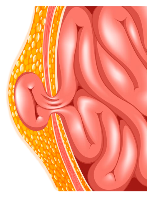 Dr. Álvaro Apéstegui, cirujano especialista en hernias de pared abdominal, Costa Rica